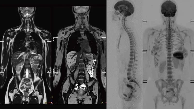 AI搭載の新型MRI