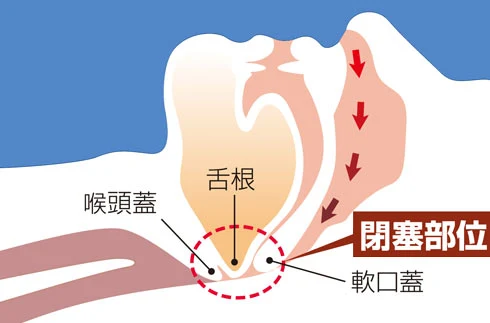 OSASで塞がった気道の断面図