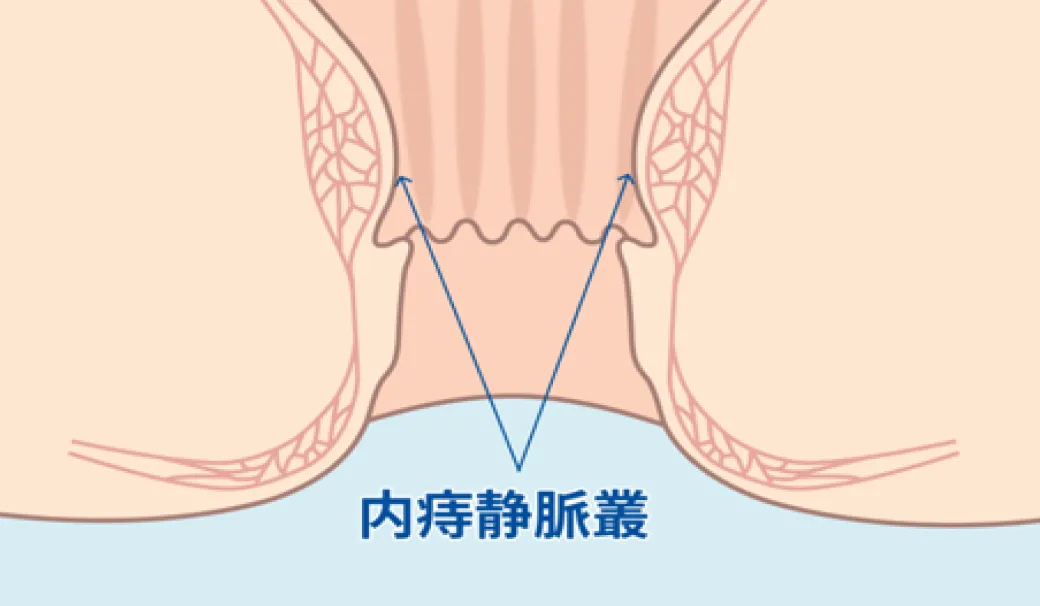 肛門の内側にある内痔静脈叢を示した断面図