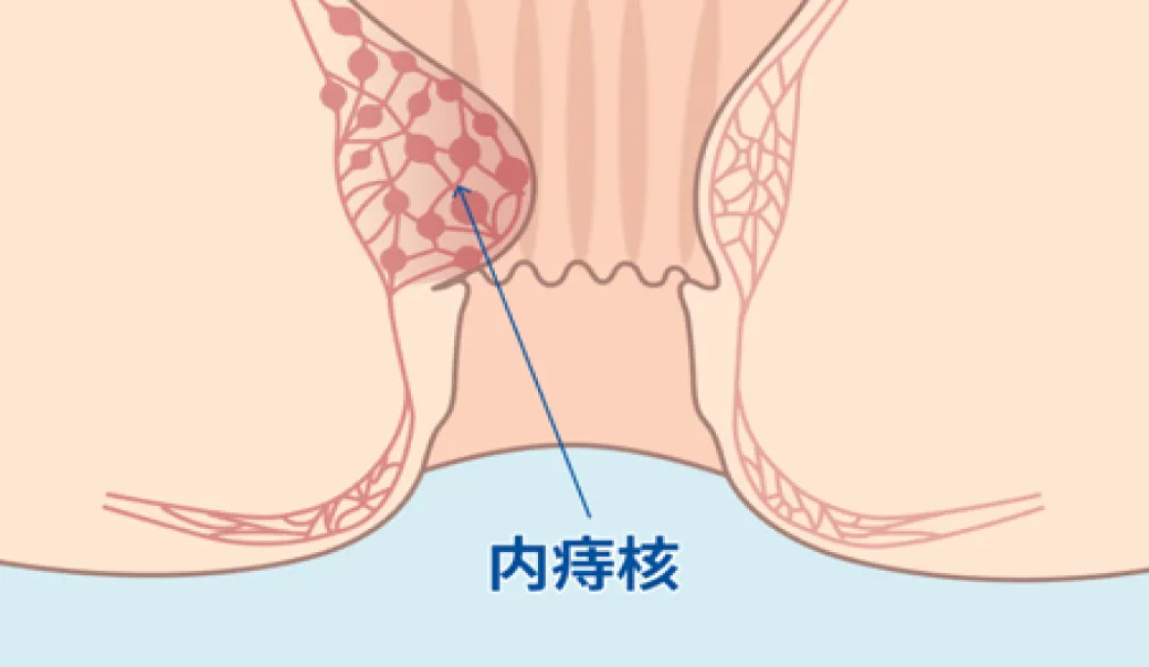 内痔静脈叢がうっ血して内痔核になった断面図