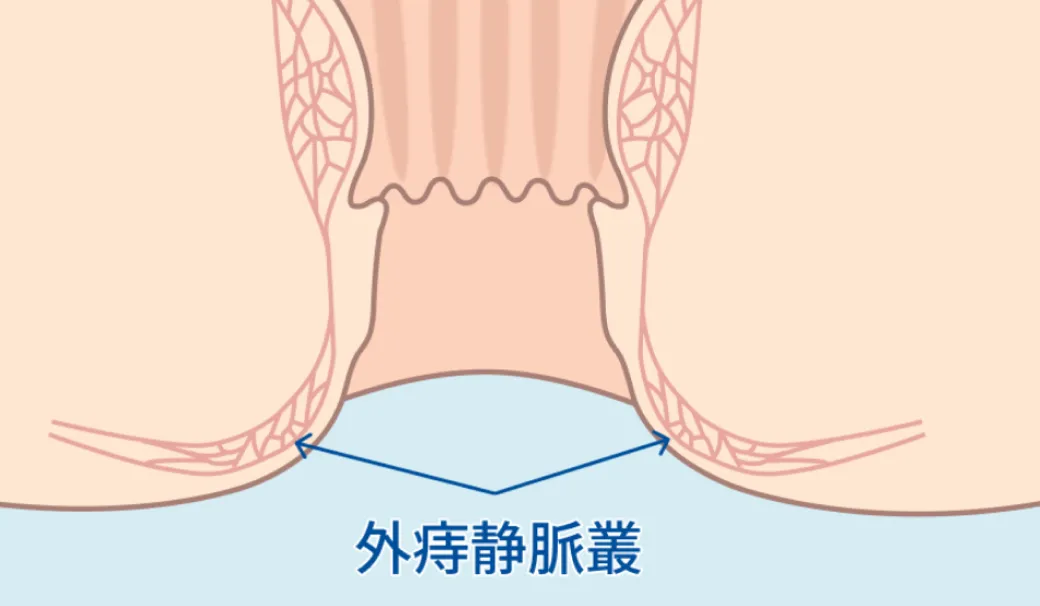 肛門の外側にある外痔静脈叢を示した断面図