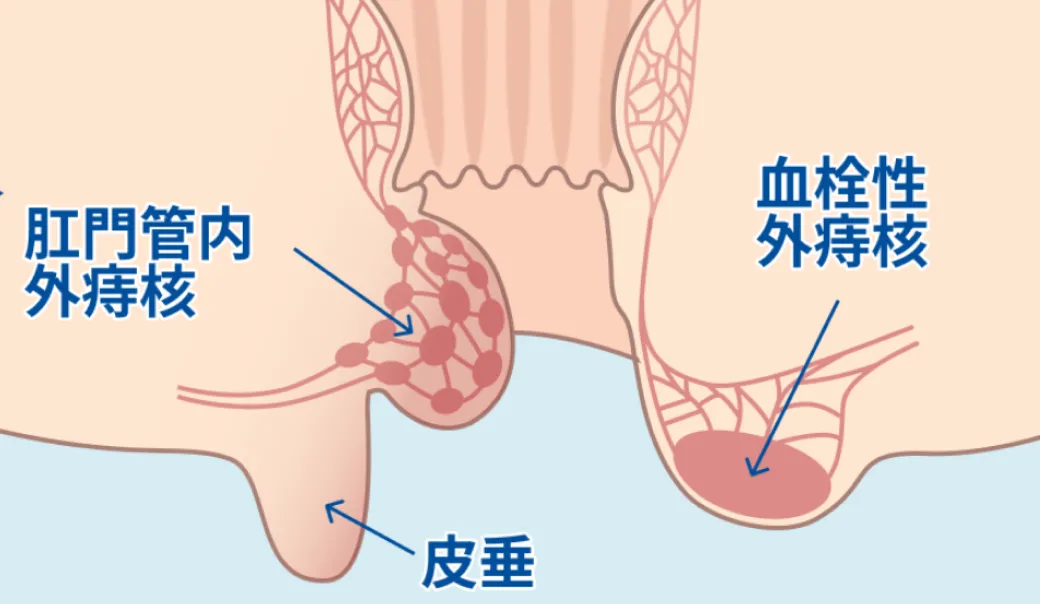 外痔静脈叢がうっ血して外痔核になった断面図