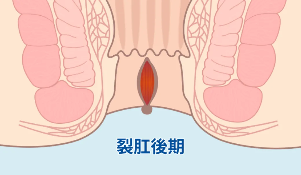 裂肛が深くなり括約筋に影響した状態の断面図