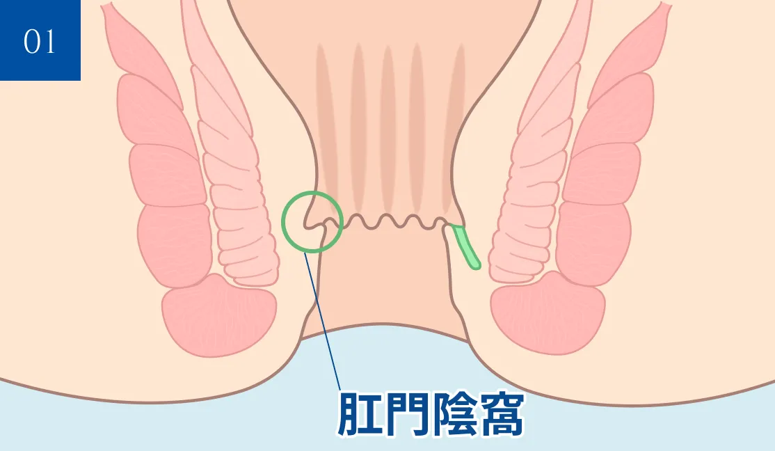 歯状線と肛門陰窩の位置を示した断面図