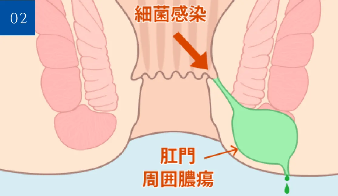 肛門陰窩から細菌が侵入する様子の断面図