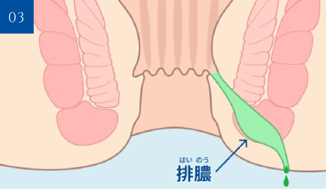 肛門周囲膿瘍から排膿している状態の断面図