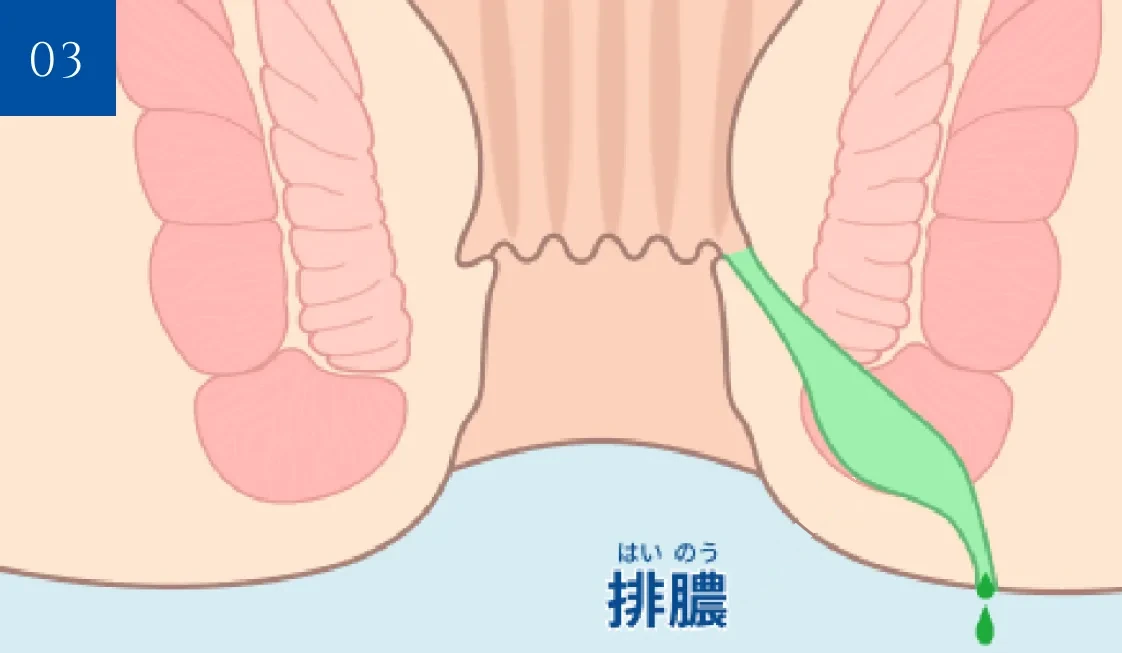 肛門周囲膿瘍から排膿している状態の断面図