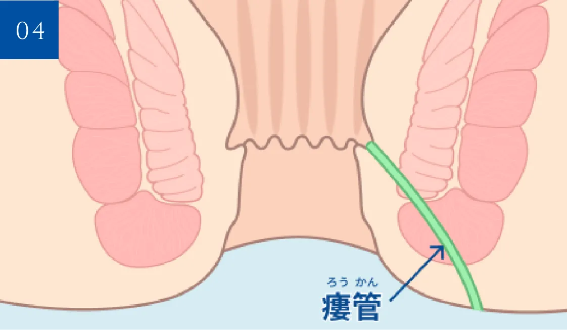 膿の通り道（瘻管）が残った痔ろうの断面図