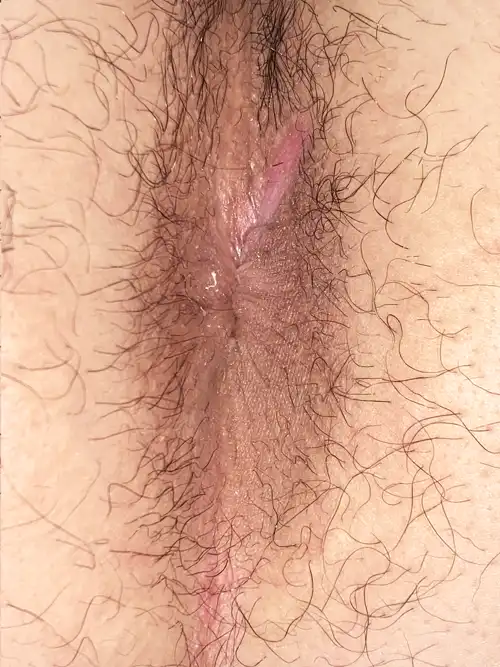 手術後5週間の症例写真