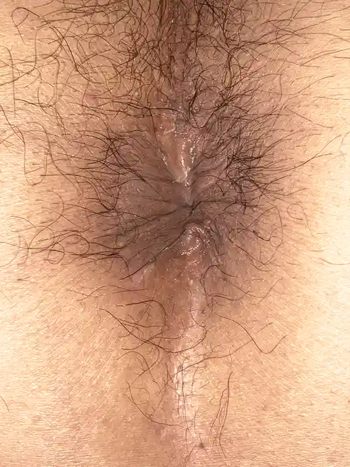 手術後3週間の症例写真