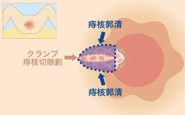 クランプ痔核切除創の両側から、皮膚・粘膜の下にある痔核を取り除く痔核郭清のイラスト