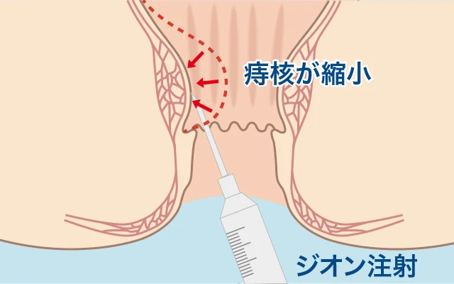 ジオン注射で痔核を硬化・縮小させるイラスト