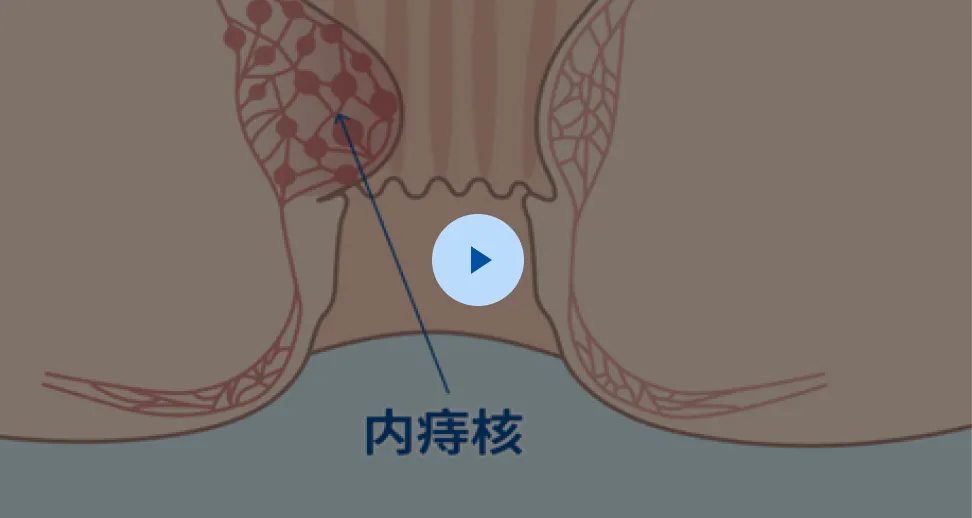 クランプトレーザー法®の解説動画イメージ