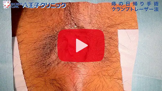 いぼ痔の手術動画2のサムネイル