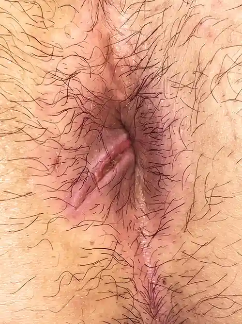 1週間後の症例写真