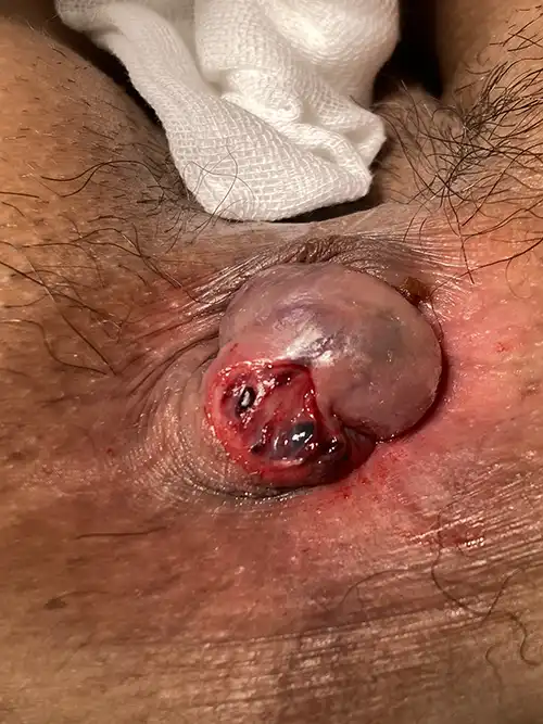 痔核脱出時の症例写真