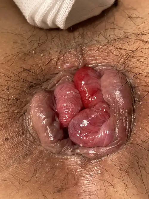 痔核脱出時の症例写真