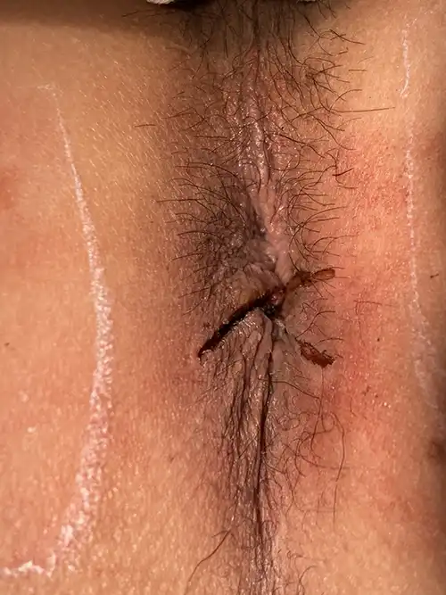 手術直後の症例写真