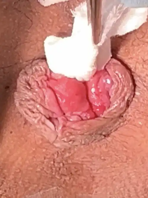 ガーゼ引き出し法にて脱出確認の症例写真