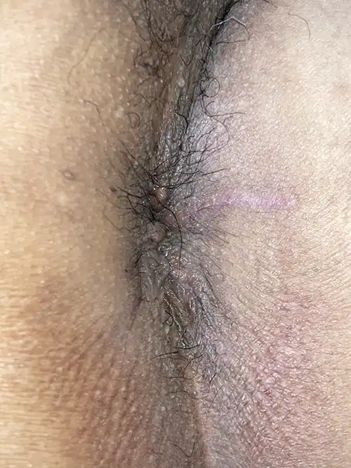 手術3週間後の症例写真