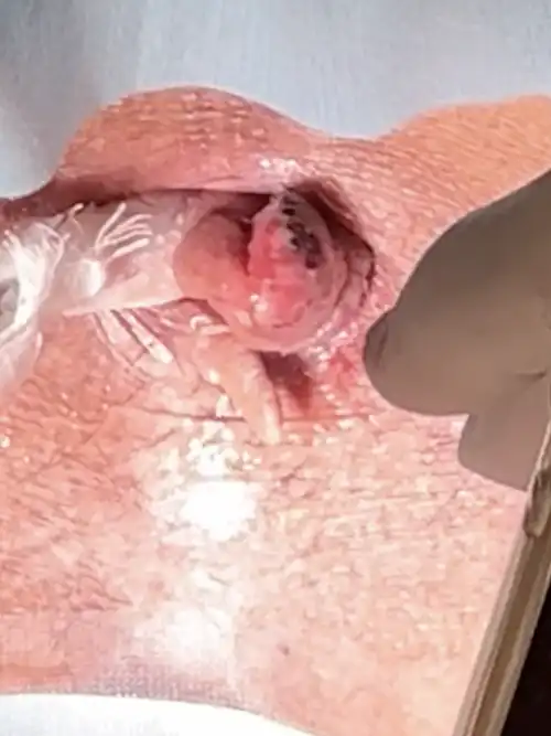 ガーゼ引き出し法の症例写真