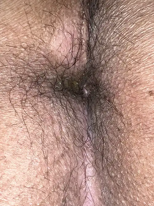 手術３週間後の症例写真