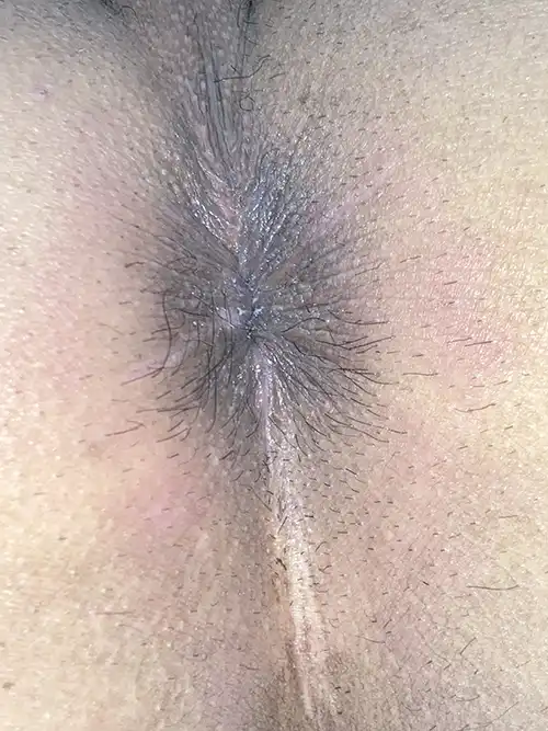 手術3週間後の症例写真